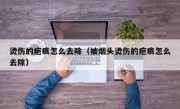 烫伤的疤痕怎么去除（被烟头烫伤的疤痕怎么去除）