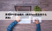 男性HPV感染图片（男性hpv感染有什么表现）