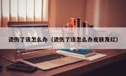 烫伤了该怎么办（烫伤了该怎么办皮肤发红）