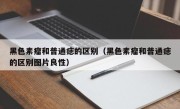黑色素瘤和普通痣的区别（黑色素瘤和普通痣的区别图片良性）